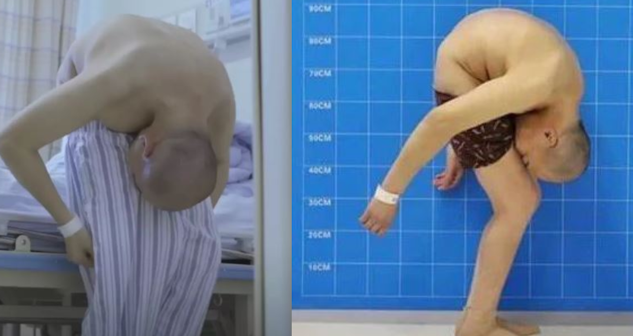Bacak arasından yemek yiyen adamın son hali inanılmaz: 30 yıl kat kat yaşamıştı